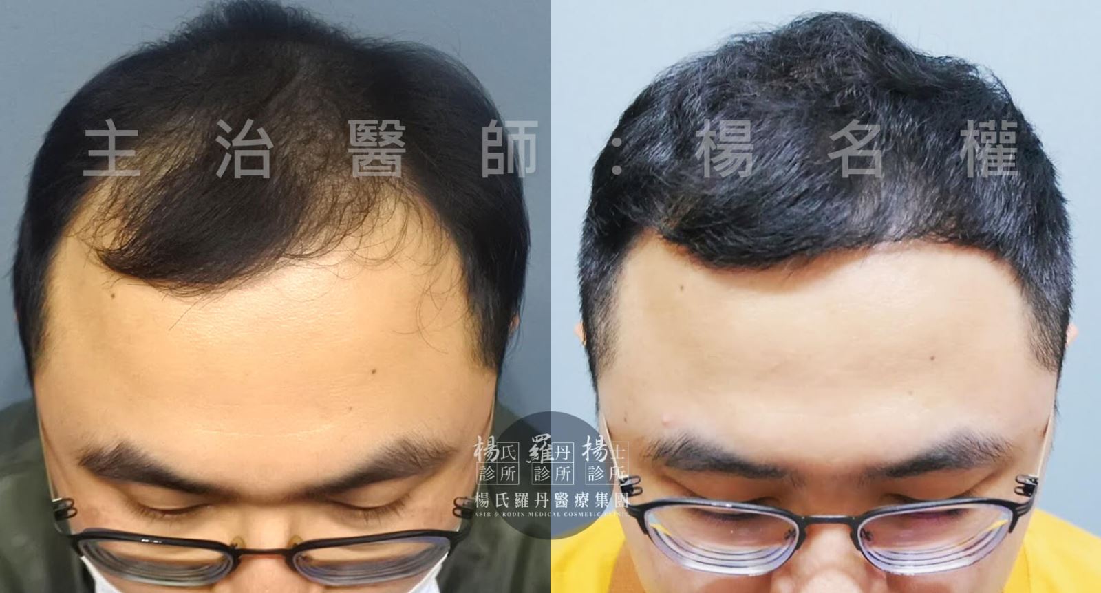 生髮 禿頭 楊氏羅丹 掉髮 六合一三階段雄性禿治療